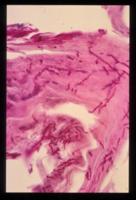 dermatophytose-a-microsporum-persicolor7