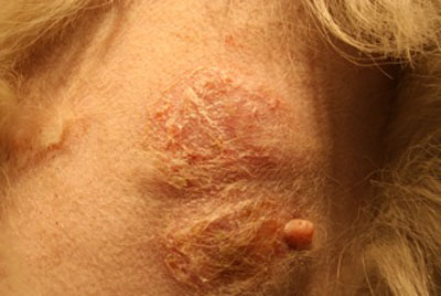 dermatophytose-atypique7-jpeg
