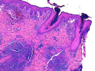 dermatophytose-atypiqueh1-jpeg