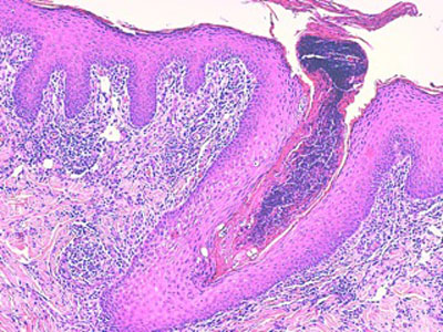 dermatophytose-atypiqueh2-jpeg