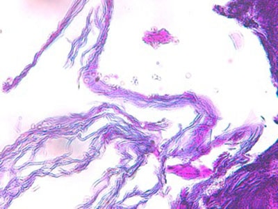 dermatophytose-atypiqueh3-jpeg