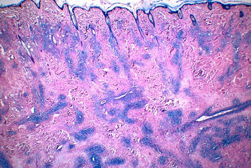 histiocytose-cutanee4