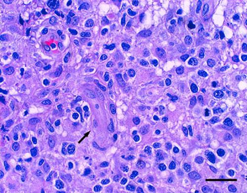 histiocytose-cutanee5