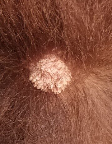 Un Cas de Dermatite Psoriasiforme Lichénoïde Un Cas de Dermatite Psoriasiforme Lichénoïde