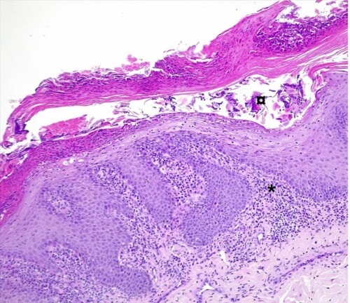 Un cas de pemphigus érythémateux sur un chien.