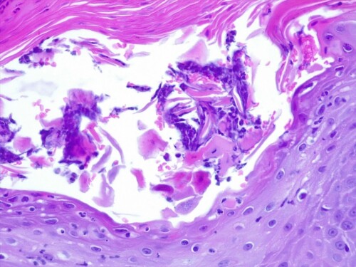 Un cas de pemphigus érythémateux sur un chien.
