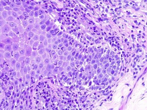 Un cas de pemphigus érythémateux sur un chien.