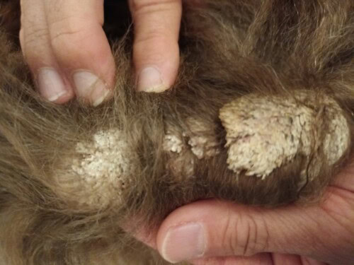 Un Cas de Dermatite Psoriasiforme Lichénoïde Un Cas de Dermatite Psoriasiforme Lichénoïde