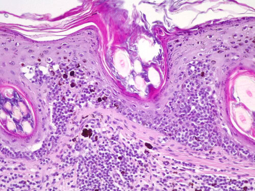 Un cas de mycosis fungoides traité par la lomustine avec possible fibrose pulmonaire