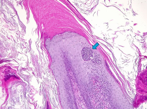 Un Cas de Dermatite Psoriasiforme Lichénoïde Un Cas de Dermatite Psoriasiforme Lichénoïde