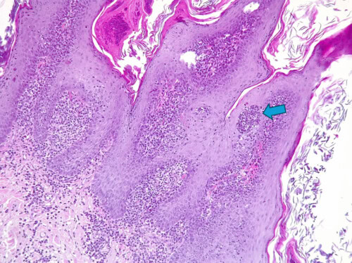 Un Cas de Dermatite Psoriasiforme Lichénoïde Un Cas de Dermatite Psoriasiforme Lichénoïde