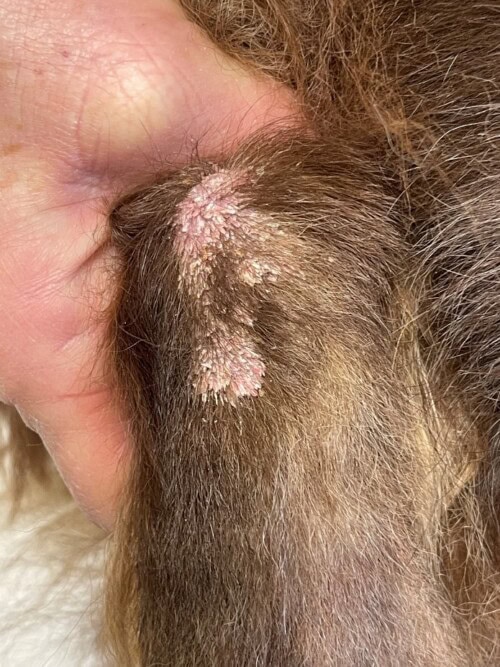 Un Cas de Dermatite Psoriasiforme Lichénoïde Un Cas de Dermatite Psoriasiforme Lichénoïde