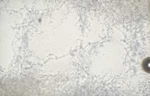 kerion-trichophyton-mentagrophytes4