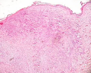 leishmaniose-nodulaire-chez-jeune-boxer6