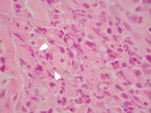 leishmaniose-nodulaire-chez-jeune-boxer7