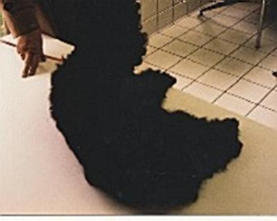 syndrome-de-cushing-spontane-corticotherapie1