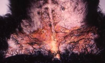 syndrome-de-cushing-spontane-corticotherapie4
