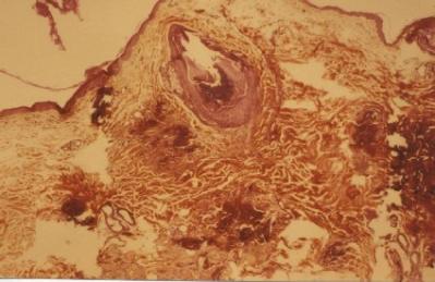 syndrome-de-cushing-spontane-corticotherapie6