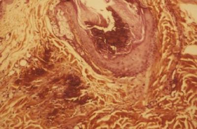 syndrome-de-cushing-spontane-corticotherapie7